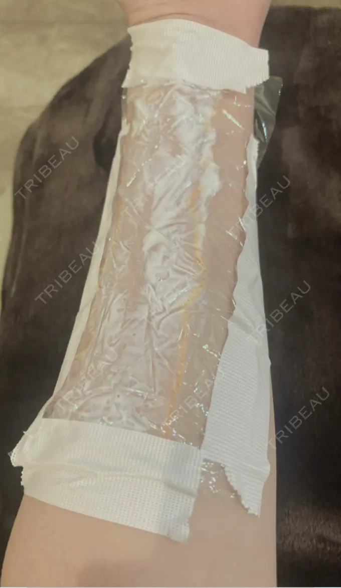 傷跡修正 きずときずあとのクリニック 銀座院 DAY 44 メイン用