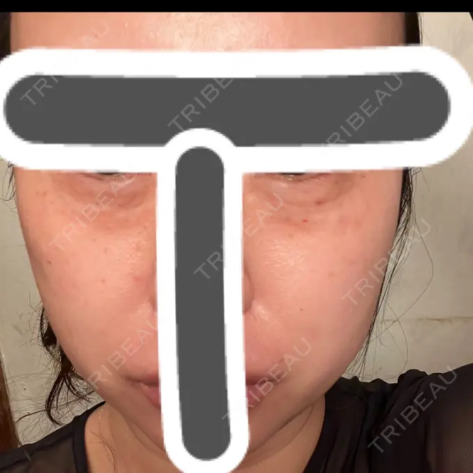 その他（肌） 湘南美容クリニック 名古屋駅本院 DAY 0 メイン用