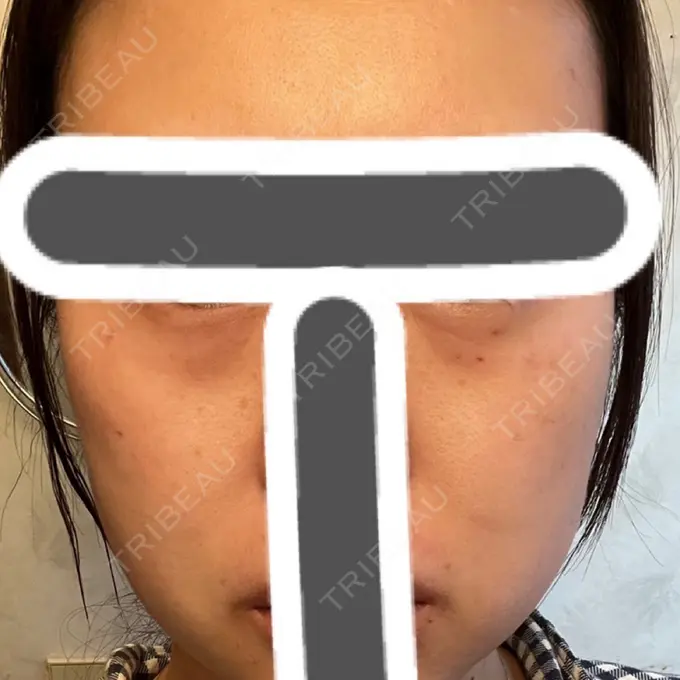 その他（肌） 湘南美容クリニック 名古屋駅本院 AFTER メイン用