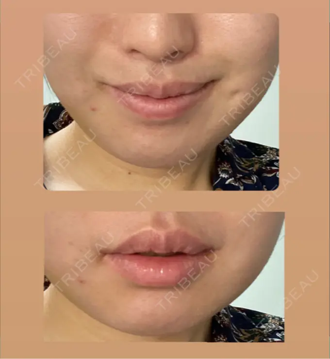 人中短縮 / 口唇縮小術 / 口角挙上 新宿ラクル美容外科クリニック 新宿院 DAY 100 メイン用