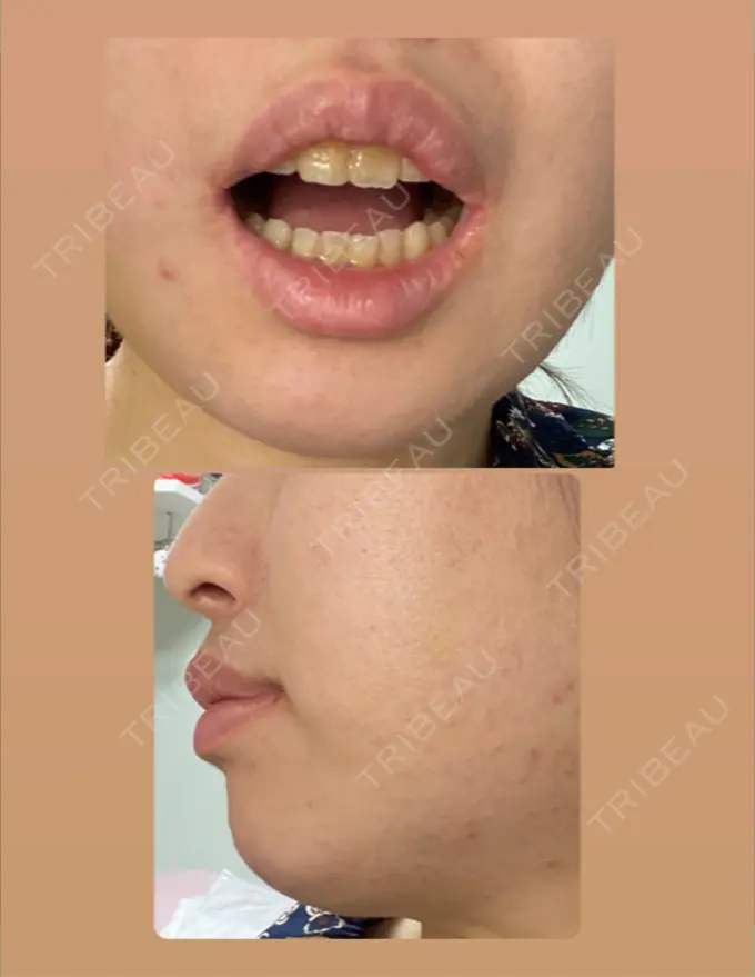 人中短縮 / 口唇縮小術 / 口角挙上 新宿ラクル美容外科クリニック 新宿院 DAY 100 メイン用