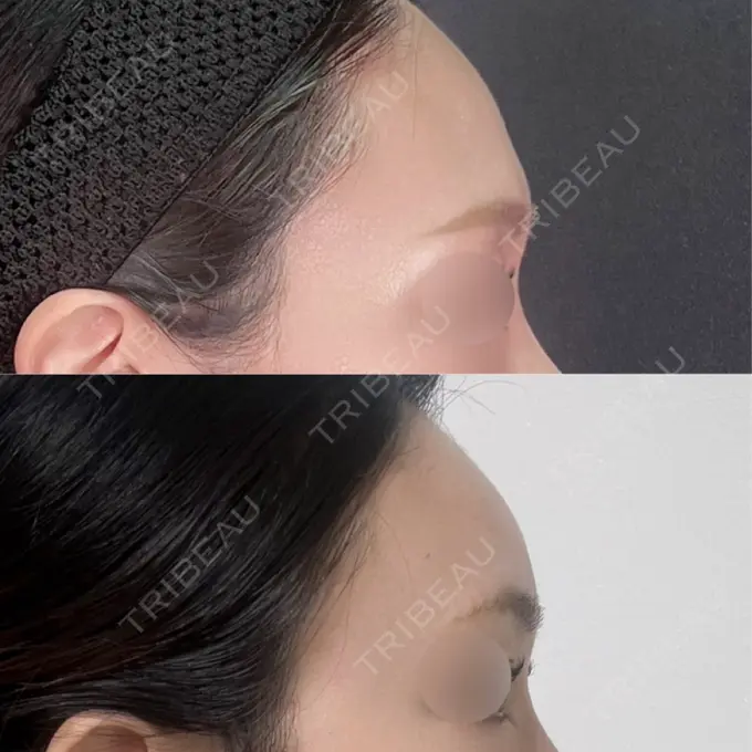 ヒアルロン酸注入（額） / ヒアルロン酸注入（こめかみ） ジョウクリニック 大阪院 AFTER メイン用