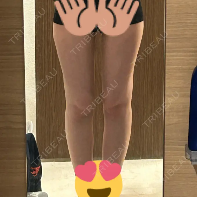 脂肪吸引（脚） Mods Clinic（モッズクリニック） 名古屋院 DAY 88 メイン用