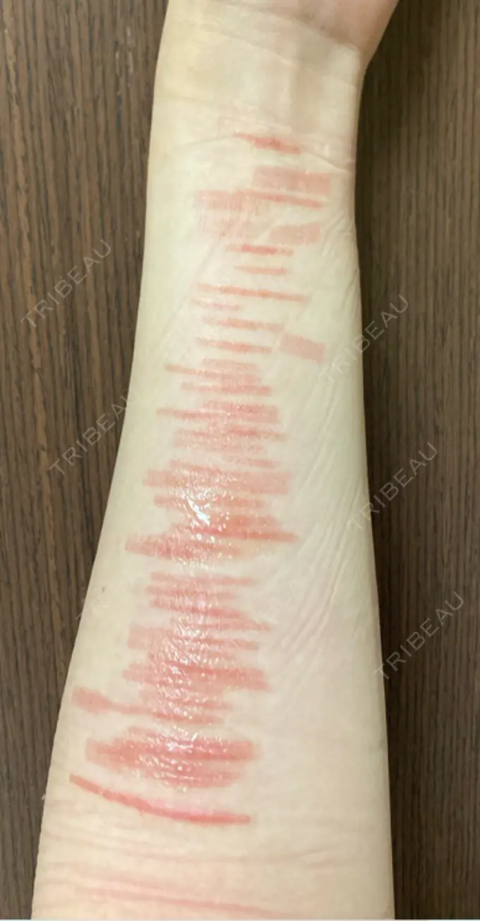 傷跡修正 きずときずあとのクリニック 銀座院 DAY 45 メイン用