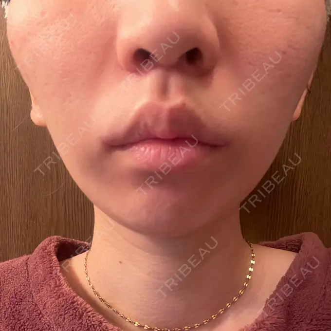人中短縮 / 口角挙上 新宿ラクル美容外科クリニック 新宿院 DAY 30 メイン用