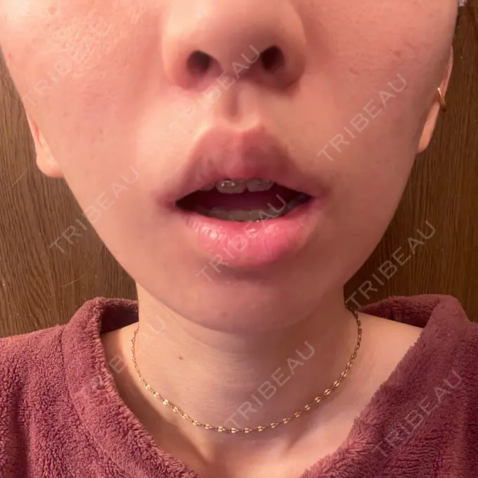 人中短縮 / 口角挙上 新宿ラクル美容外科クリニック 新宿院 DAY 30 メイン用