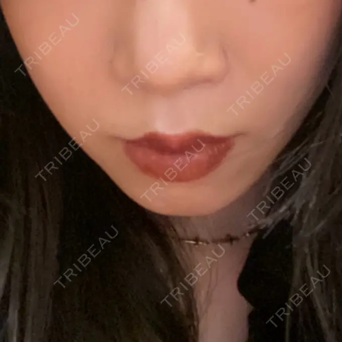 人中短縮 / 鼻翼挙上 / 鼻尖縮小 Otus Clinic 【オータスクリニック】 DAY 85 メイン用