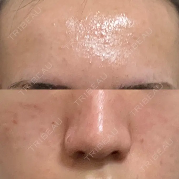 ピーリング（ニキビ・毛穴） SK新宿歌舞伎町美容外科・歯科 DAY 1 メイン用