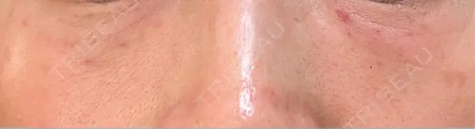 ボトックス（エラ・小顔） / 肌育注射（ジュベルックなど） / ピコスポット APスキンクリニック銀座 DAY 3 メイン用