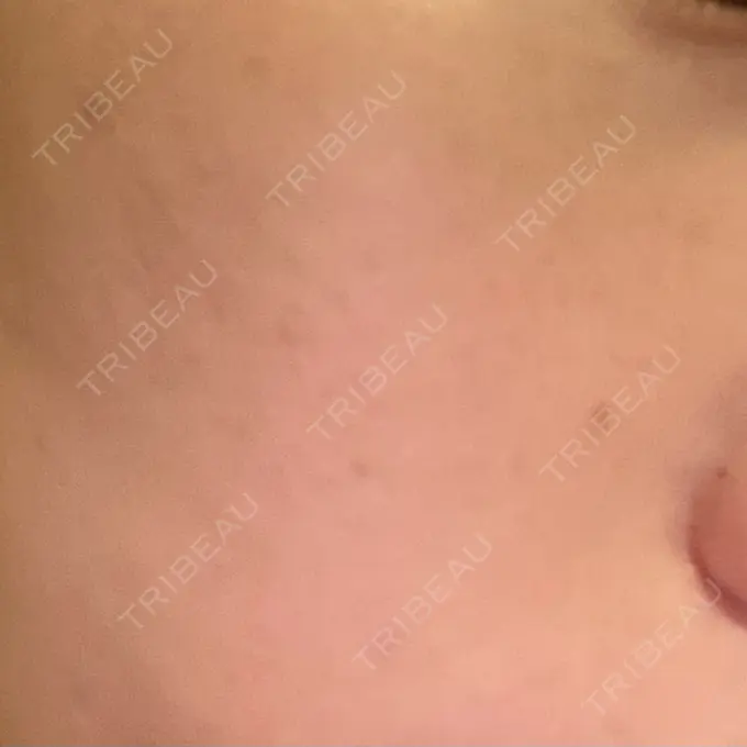 ピーリング（ニキビ・毛穴） 大美会クリニック 梅田院 AFTER メイン用