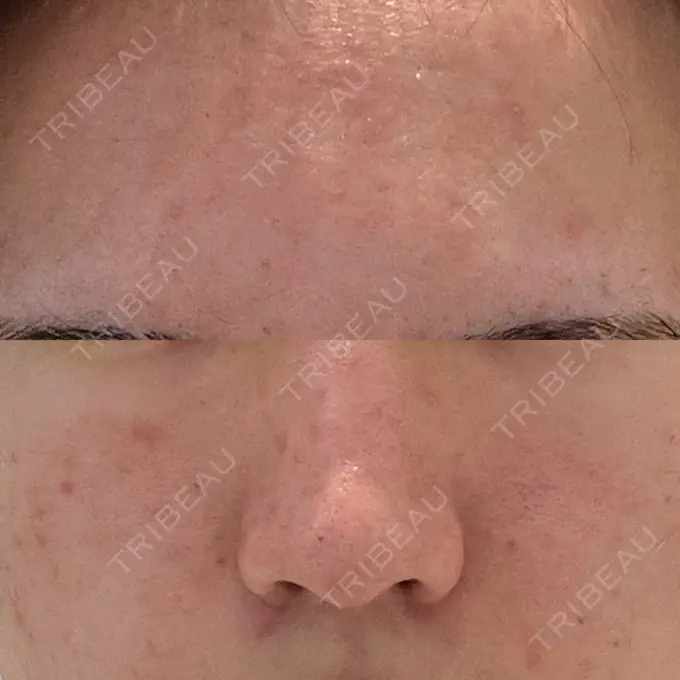 ピーリング（ニキビ・毛穴） SK新宿歌舞伎町美容外科・歯科 DAY 2 メイン用