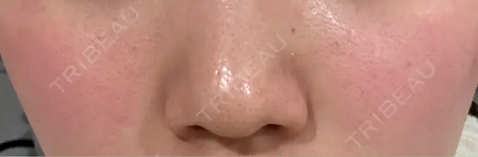 医療脱毛（顔） / 医療脱毛（ワキ） 神戸元町通クリニック DAY 0 メイン用