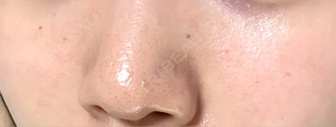 医療脱毛（顔） / 医療脱毛（ワキ） 神戸元町通クリニック AFTER メイン用