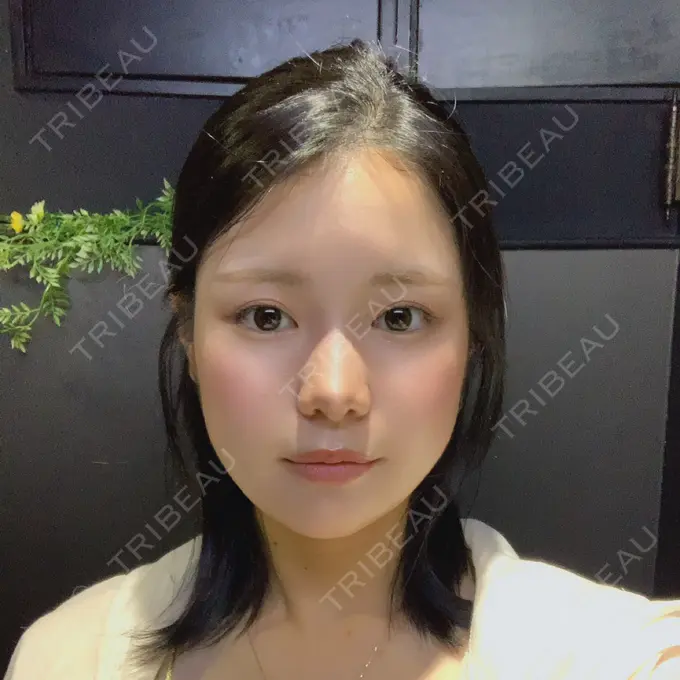 骨切り（あご） / 骨削り（エラ） / 骨削り（頬） id（アイディ）美容外科 DAY 170 メイン用