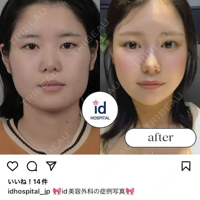 骨切り（あご） / 骨削り（エラ） / 骨削り（頬） id（アイディ）美容外科 DAY 170 メイン用