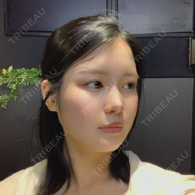 骨切り（あご） / 骨削り（エラ） / 骨削り（頬） id（アイディ）美容外科 DAY 170 メイン用