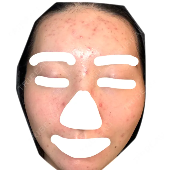 ヴェルヴェットスキン / アグネス 日本ウェルネス再生クリニック DAY 2 メイン用