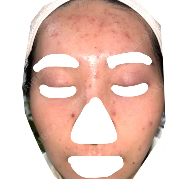 ヴェルヴェットスキン / アグネス 日本ウェルネス再生クリニック DAY 5 メイン用