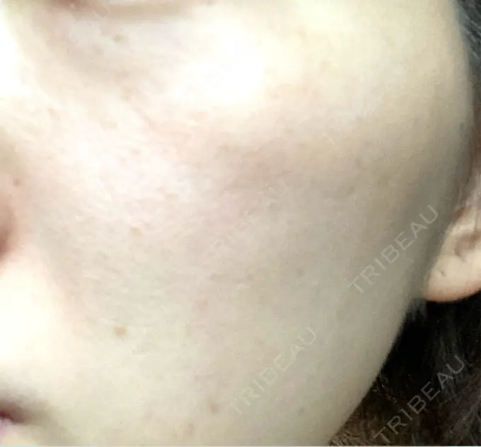 ルメッカ ルラ美容クリニック 横浜院 AFTER メイン用