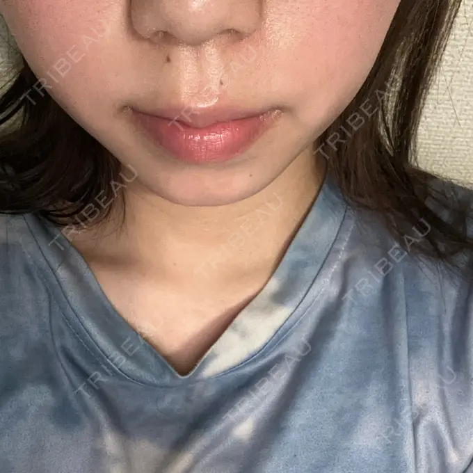 ヒアルロン酸注入（あご） フィラークリニック 名古屋栄院 DAY 68 メイン用