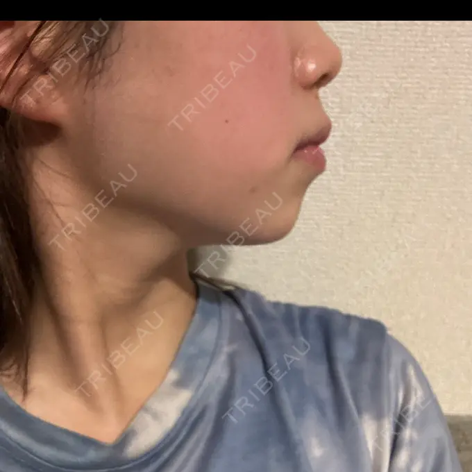 ヒアルロン酸注入（あご） フィラークリニック 名古屋栄院 DAY 68 メイン用