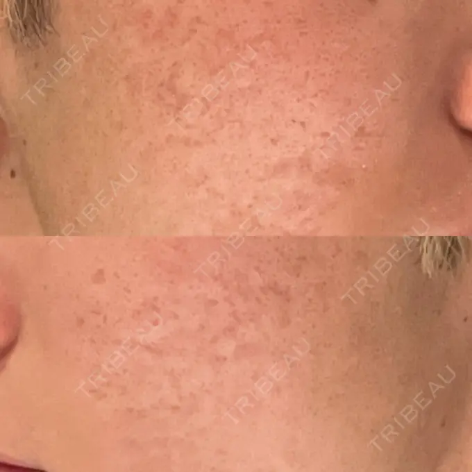 その他（肌） / ダーマペン / ニキビ治療 ゆきスキンクリニック 東池袋 AFTER メイン用