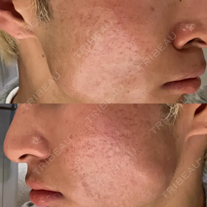 ニードルRF（ポテンツァなど） Re：HADA CLINIC 銀座 DAY 0 メイン用