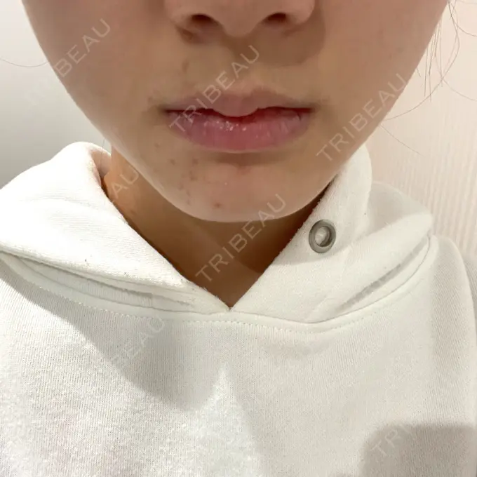 ボトックス（エラ・小顔） TCB東京中央美容外科 柏院 AFTER メイン用