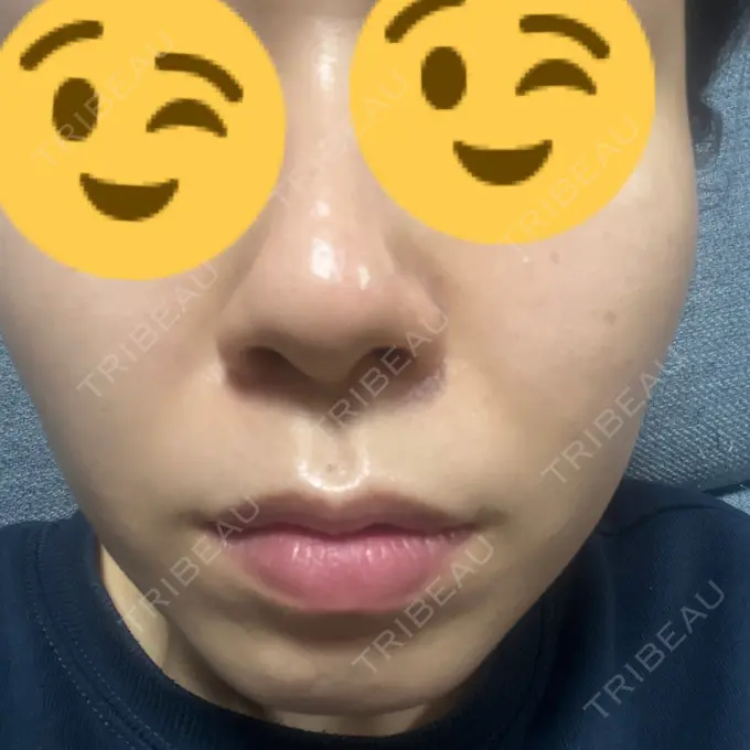 ピーリング（ニキビ・毛穴） / ピコレーザートーニング（美白・肝斑） Zetith Beauty Clinic 福岡院 AFTER メイン用