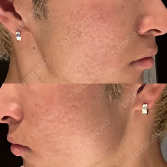 ニードルRF（ポテンツァなど） Re：HADA CLINIC 銀座 DAY 1 メイン用