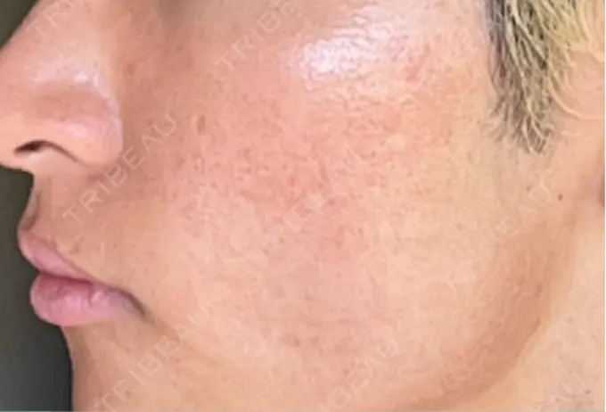 ニードルRF（ポテンツァなど） Re：HADA CLINIC 銀座 DAY 1 メイン用