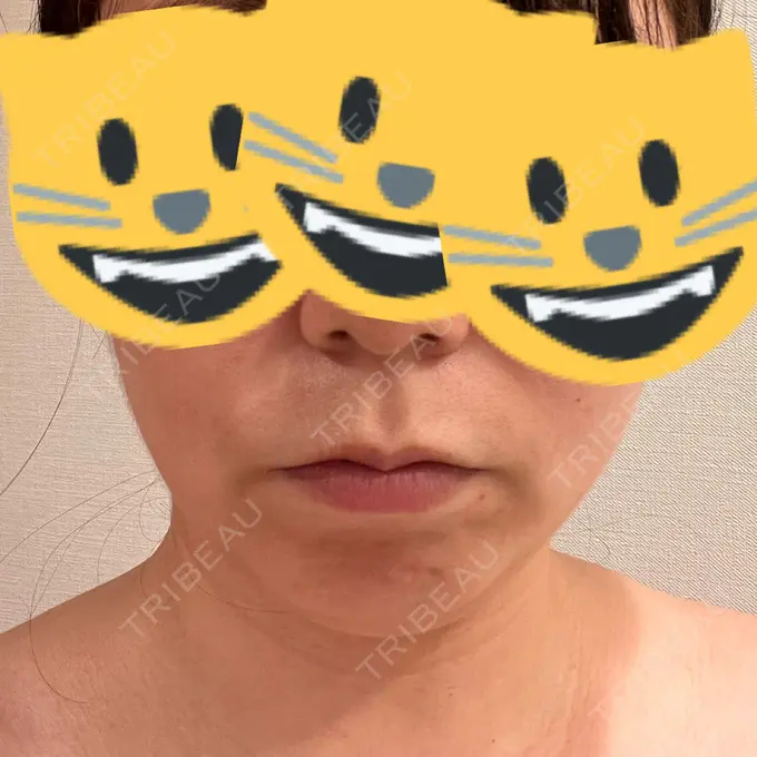 脂肪溶解注射（顔） 表参道ウィズ・クリニック AFTER メイン用