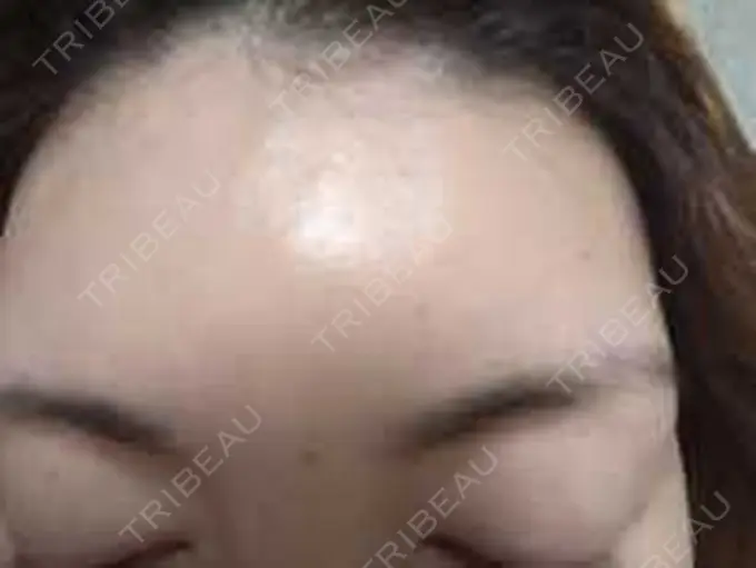 その他（肌） / リジュラン 湘南美容クリニック 仙台院 DAY 0 メイン用