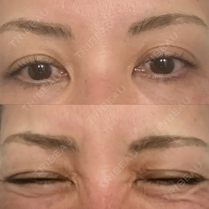 シワ取りボトックス / ボトックス（眉間） TCB東京中央美容外科 神戸院 DAY 7 メイン用