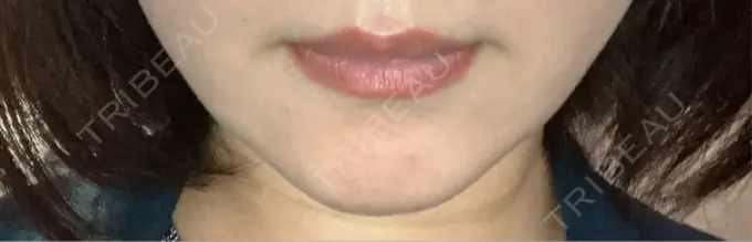 ボトックス（あご） 東京美容医療クリニック 池袋院 DAY 0 メイン用