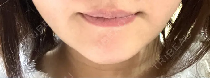 ボトックス（あご） 東京美容医療クリニック 池袋院 AFTER メイン用