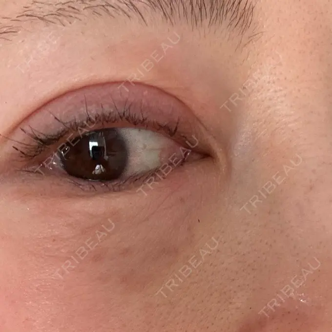 ボトックス（エラ・小顔） / 肌育注射（ジュベルックなど） / ピコスポット APスキンクリニック銀座 AFTER メイン用