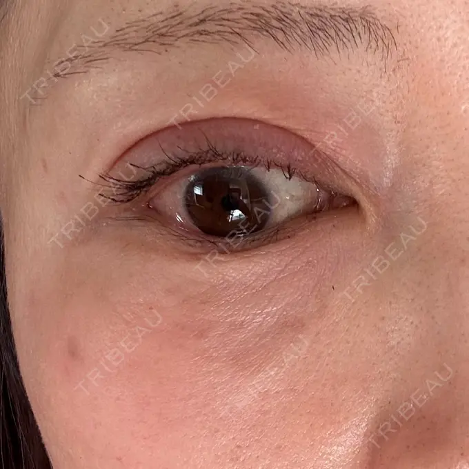 ボトックス（エラ・小顔） / 肌育注射（ジュベルックなど） / ピコスポット APスキンクリニック銀座 DAY 7 メイン用