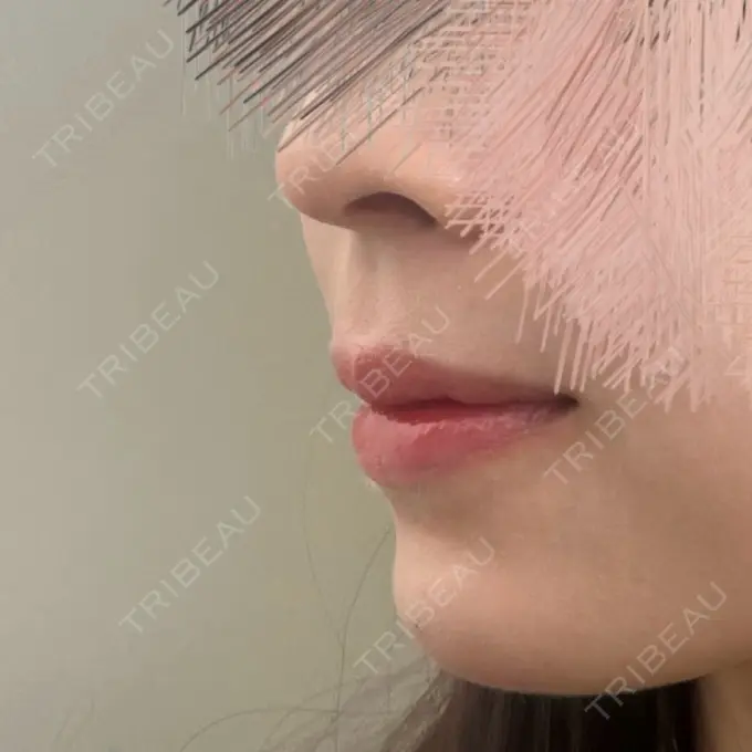 ヒアルロン酸注入（あご） 豊洲内科・糖尿病 / 形成・美容外科クリニック AFTER メイン用