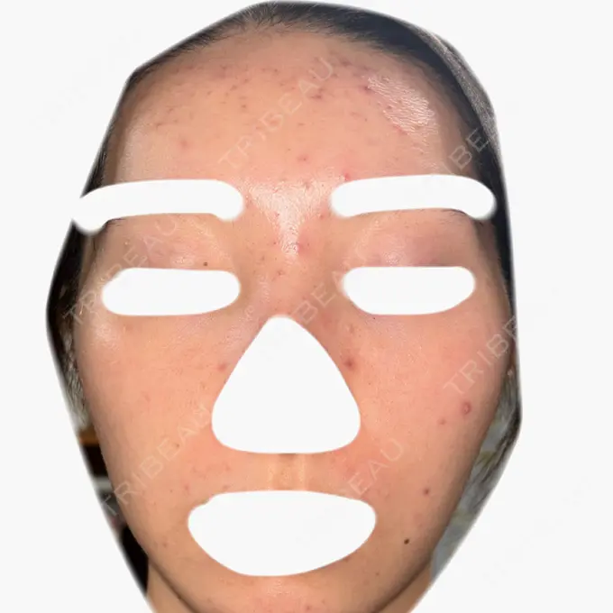 ヴェルヴェットスキン / アグネス 日本ウェルネス再生クリニック DAY 8 メイン用