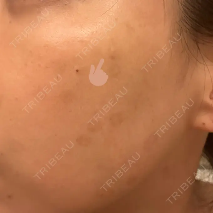 ピコレーザートーニング（美白・肝斑） G MEDICAL ART クリニック 新宿院 DAY 133 メイン用