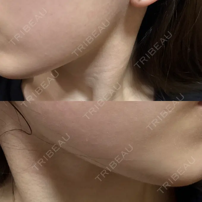 ハイフ（顔） しんゆり美容健康クリニック AFTER メイン用