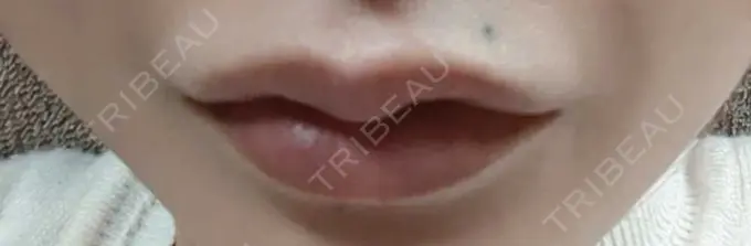 ヒアルロン酸注入（唇） / ボトックス（人中） id美容クリニック 銀座院 AFTER メイン用