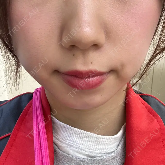 ヒアルロン酸注入（あご） フィラークリニック 名古屋栄院 DAY 72 メイン用