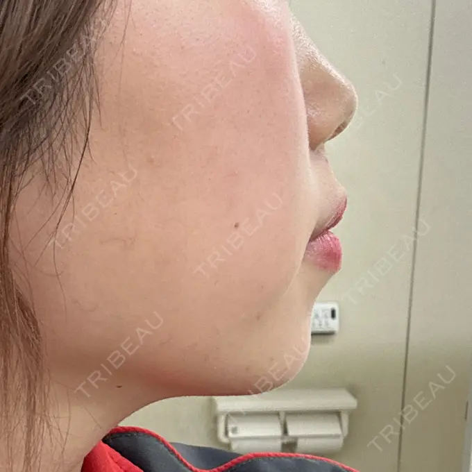 ヒアルロン酸注入（あご） フィラークリニック 名古屋栄院 DAY 72 メイン用