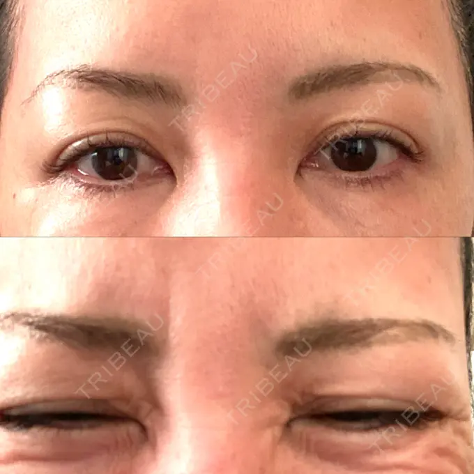 シワ取りボトックス / ボトックス（眉間） TCB東京中央美容外科 神戸院 DAY 9 メイン用