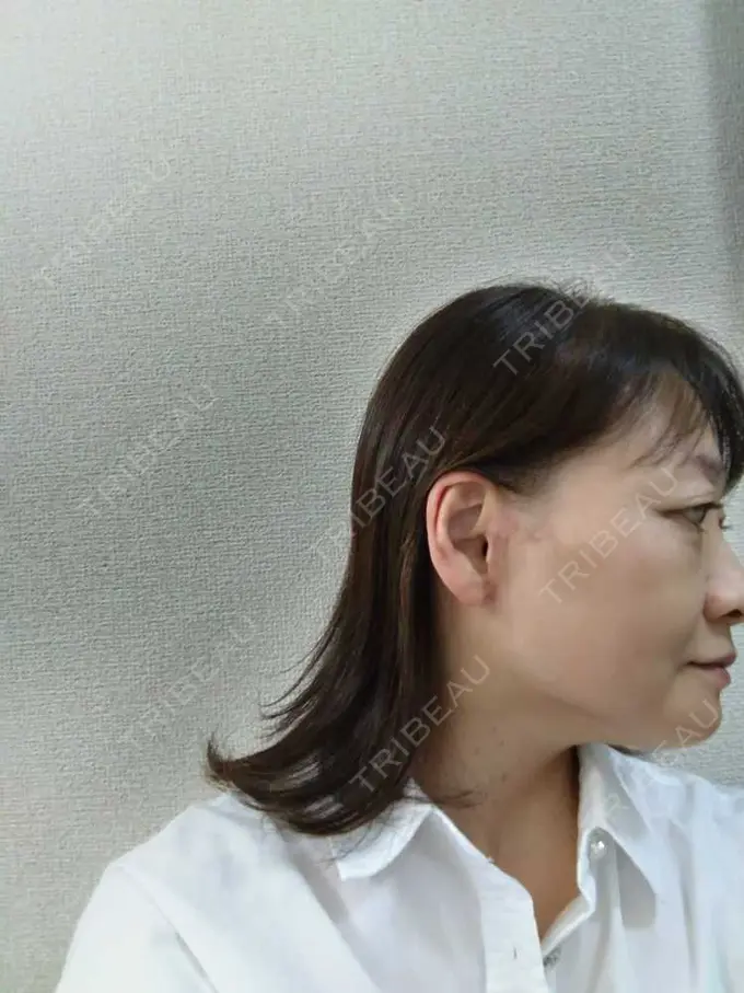 切開リフト / 肌ヒアルロン酸注入（たるみ・シワ改善） / 美肌レーザー 石倉クリニック 水戸院 DAY 91 メイン用