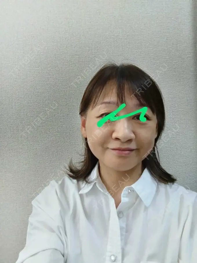 切開リフト / 肌ヒアルロン酸注入（たるみ・シワ改善） / 美肌レーザー 石倉クリニック 水戸院 AFTER メイン用