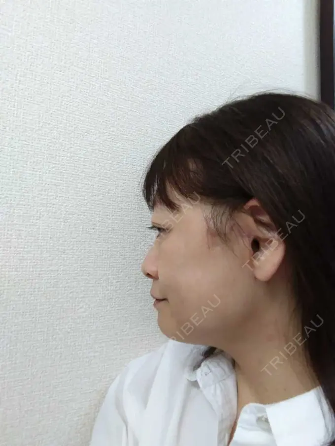 切開リフト / 肌ヒアルロン酸注入（たるみ・シワ改善） / 美肌レーザー 石倉クリニック 水戸院 DAY 91 メイン用