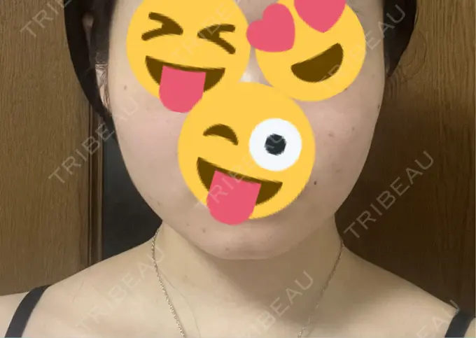 脂肪吸引（顔） Mods Clinic（モッズクリニック） 名古屋院 AFTER メイン用